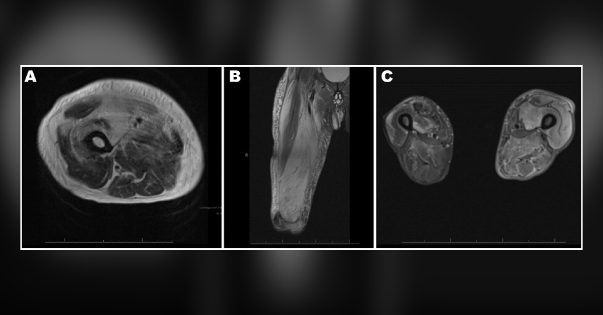 Case of a Diabetic Patient in Pain