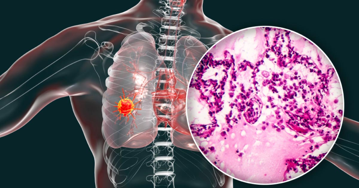 A Case Of Solitary Lung Nodule