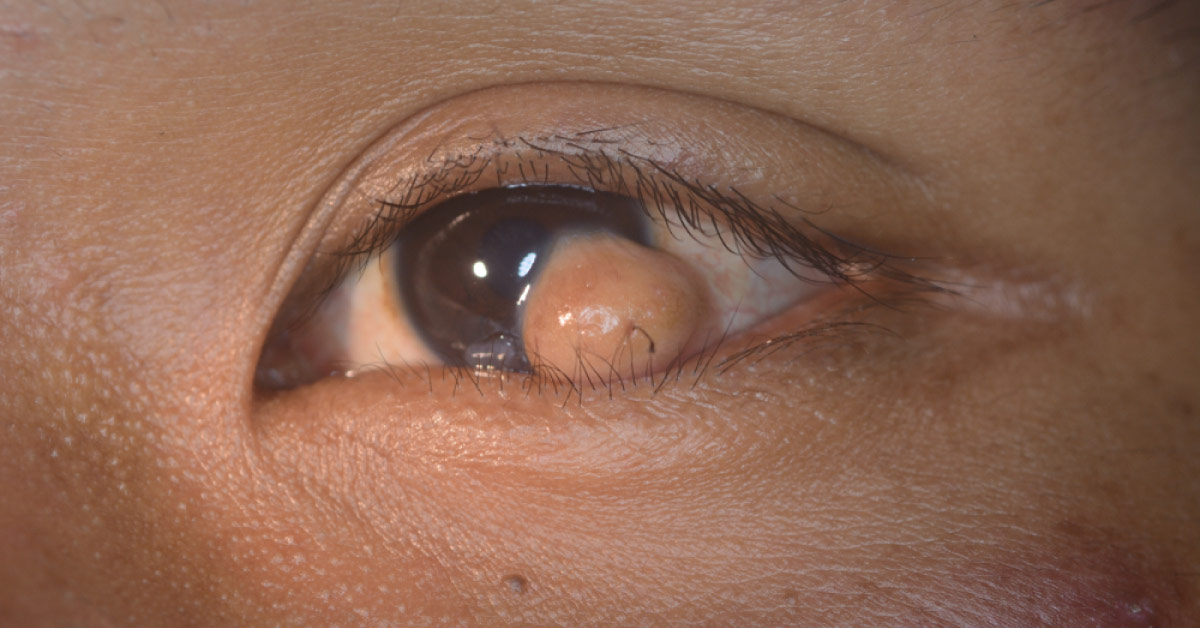 Basics Of Limbal Dermoid