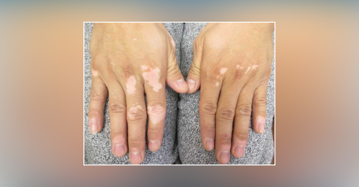Identify the White Lesions