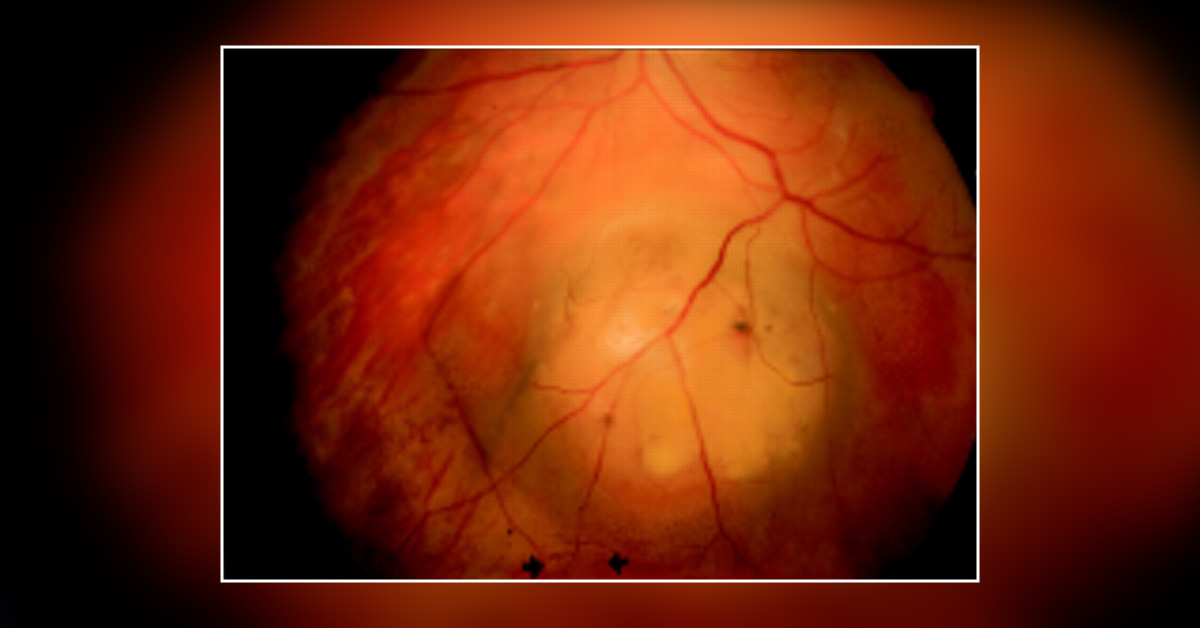Treatment Modalities Of Choroidal Melanoma