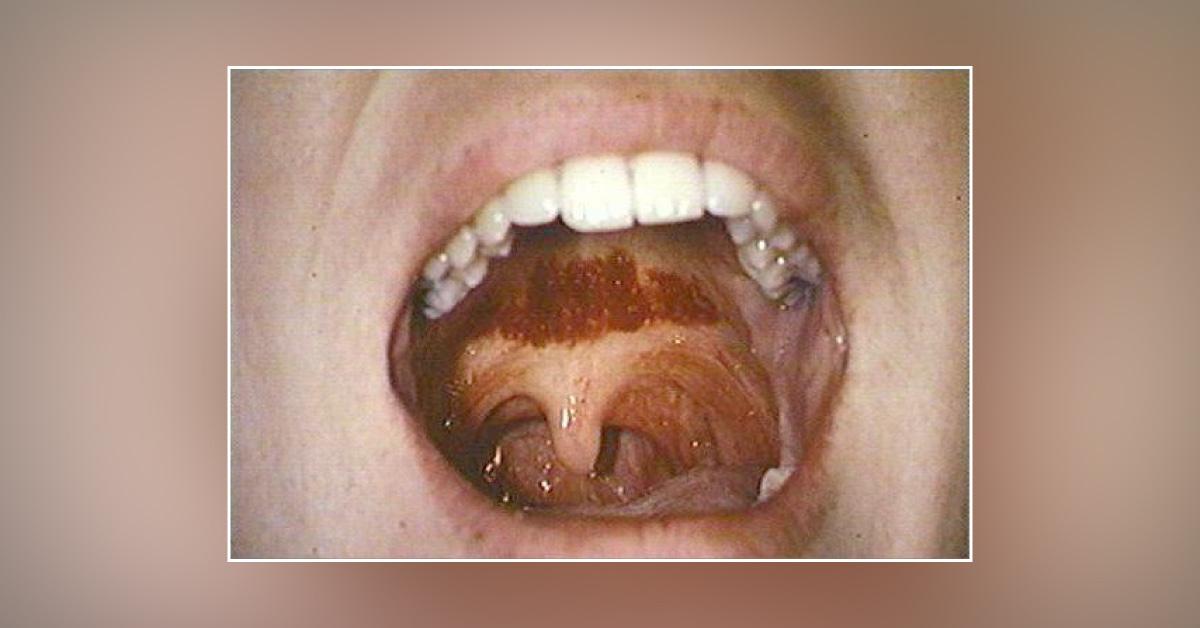 Dark Red-Blue Palate: What’s Wrong with This Woman?