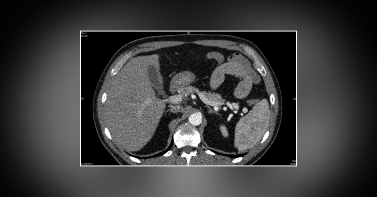 “Coffee Causing Recurrent Hypoglycemia”- Claims a Non-diabetic Patient