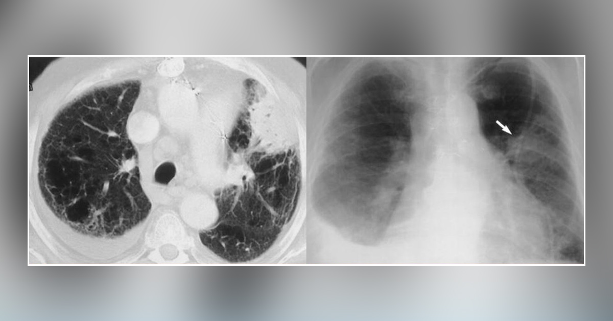 What is the Reason for Breath Shortness in This Patient?