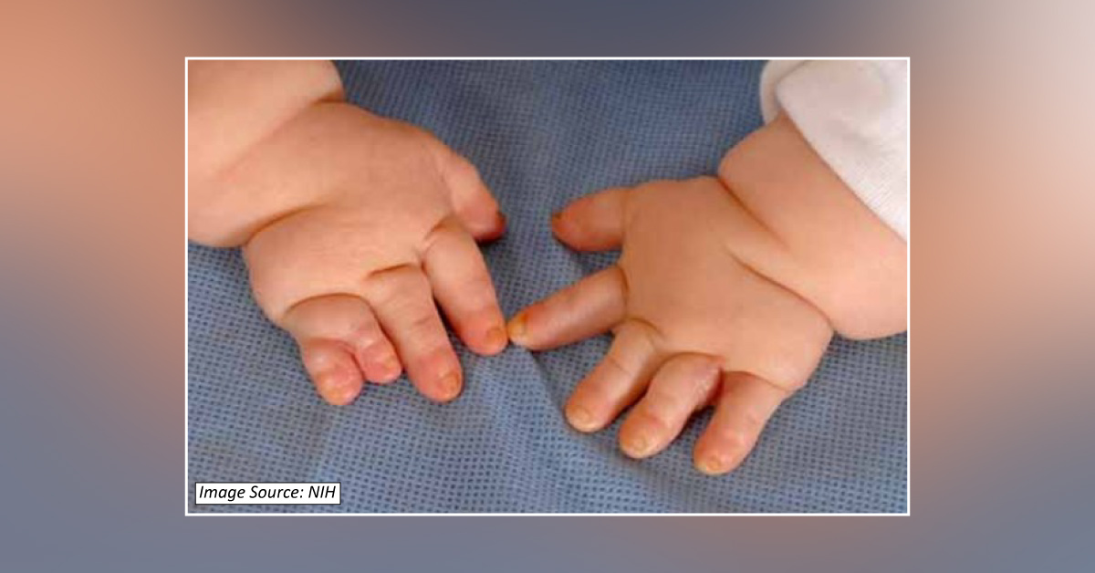 Clinical Presentation Of LMB Syndrome