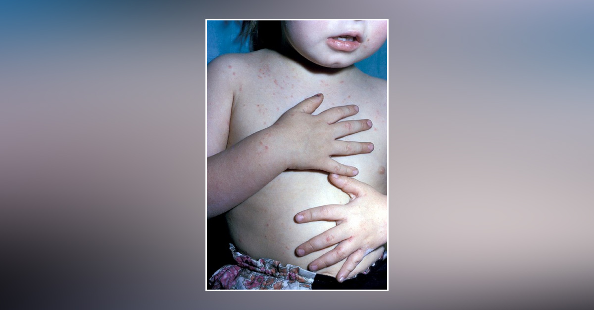 Diagnose This Case of Worsening Papular Rash