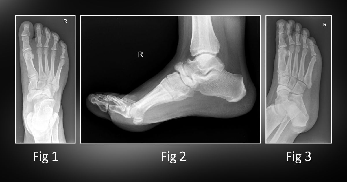 A Patchy Sclerosis at the Navicular Bone: Can You Diagnose the Condition?
