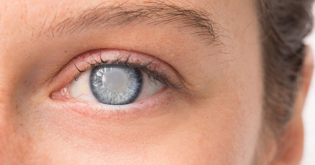 Rare Causes Of Cataract