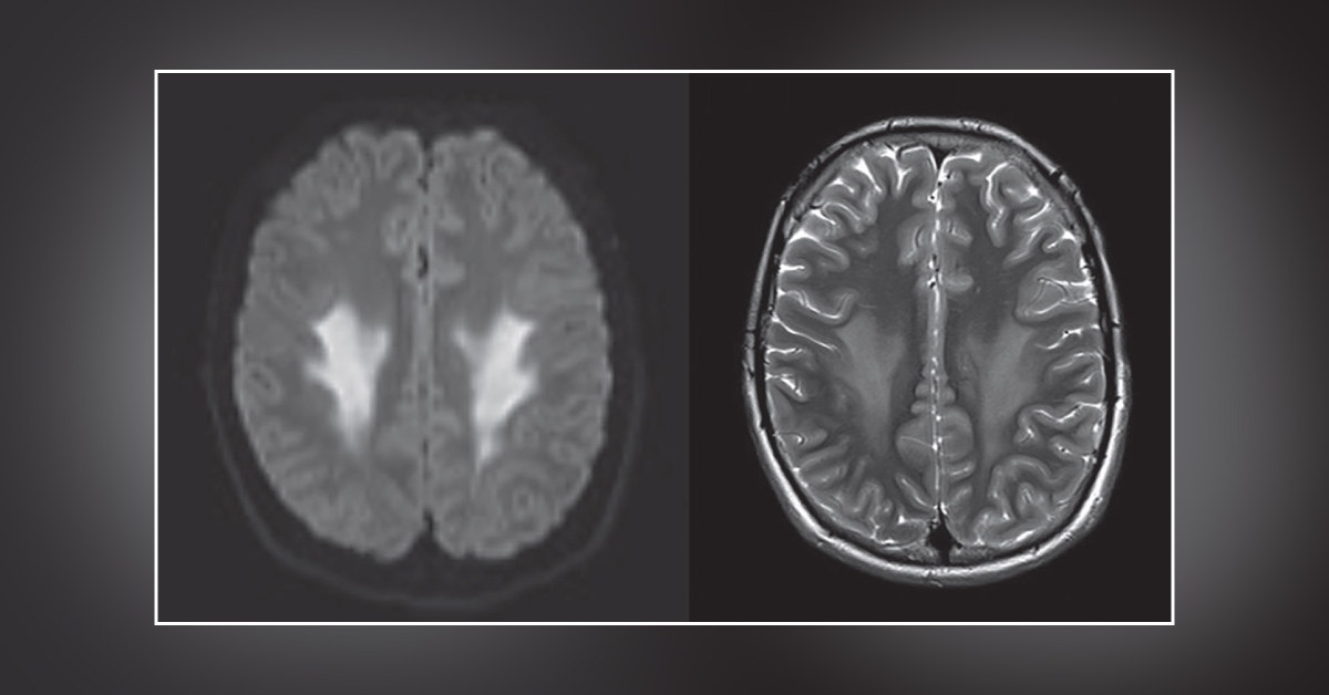 Identify the Reason Behind This Rare Stroke-like Presentation