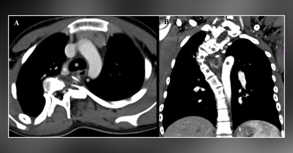 A Case of Neurofibromatosis