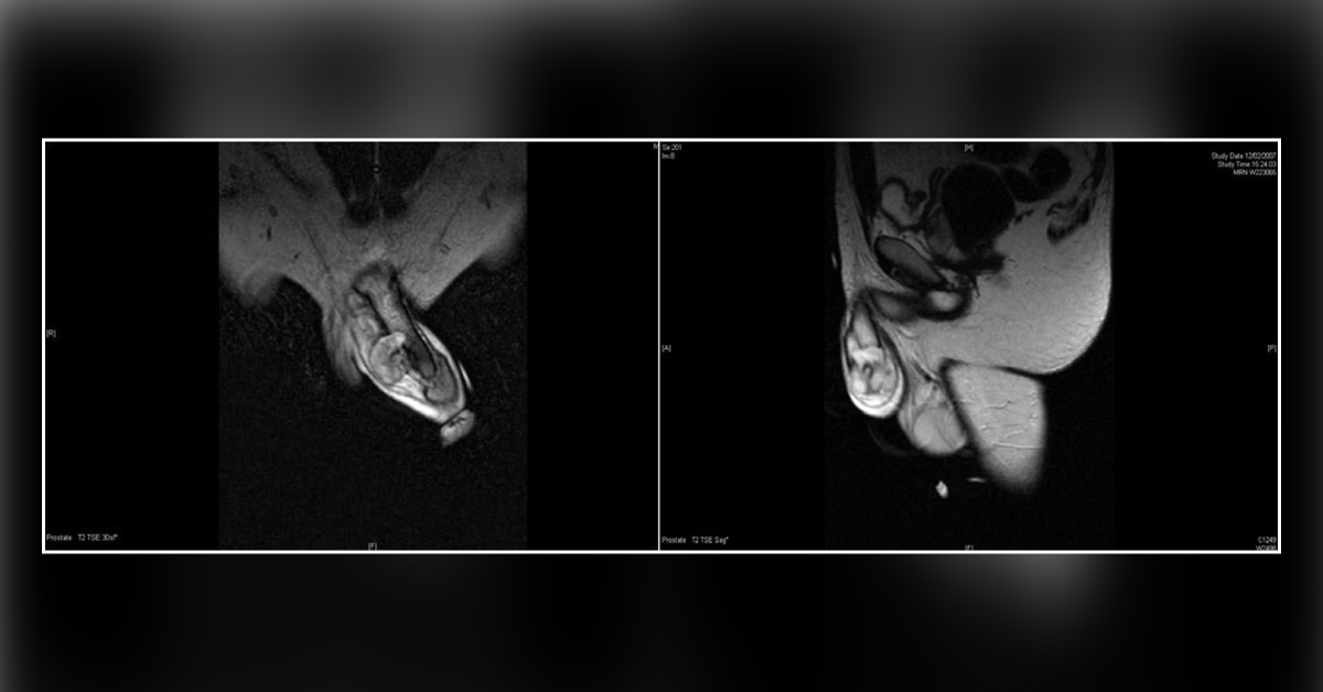 Case of a Man with Acute-onset Penile Pain