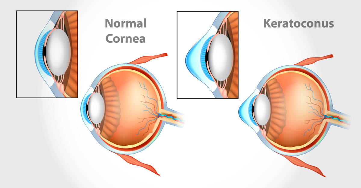 medical disorders associated with keratoconus