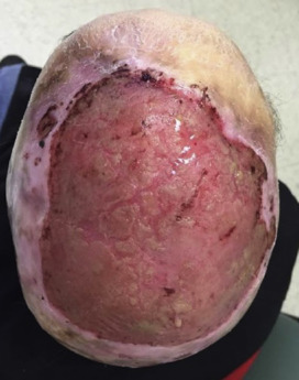 Case Report Of A Burn Rash