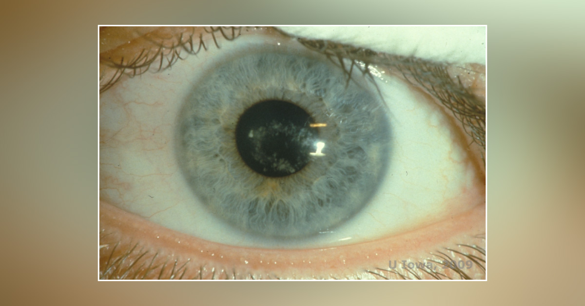 Brief Post On Congenital Corneal Dystrophy