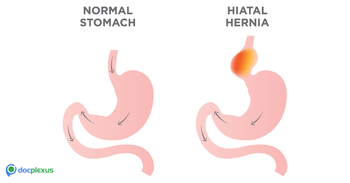 How Do You Manage Hiatal Hernia?