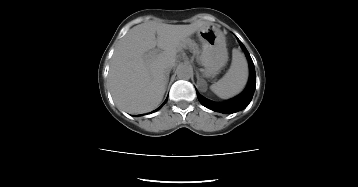 Case of a Female with Hypokalemic Metabolic Alkalosis