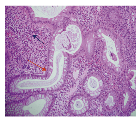 A Case of Atypical Osteomyelitis