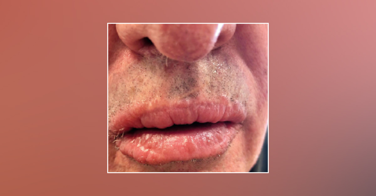 Why are my Lips Appearing Swollen?