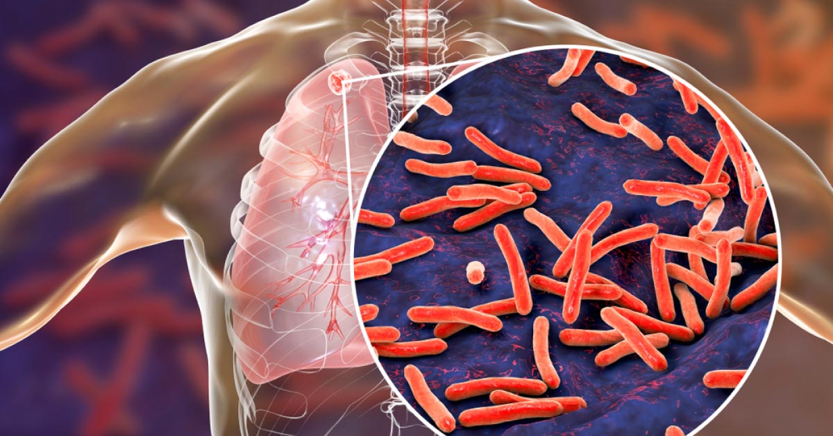 It's Time To End TB