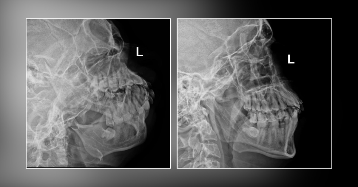A Case of Jaw Trauma