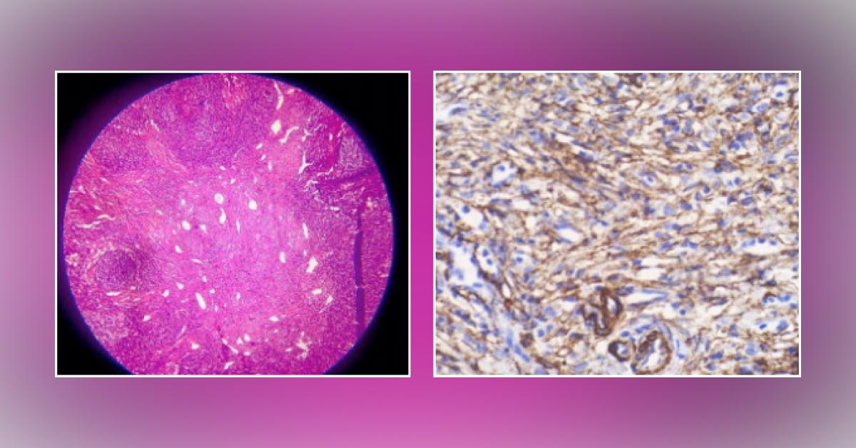 An Inguinal Lymph Mass in a Young Girl: What's the Diagnosis?
