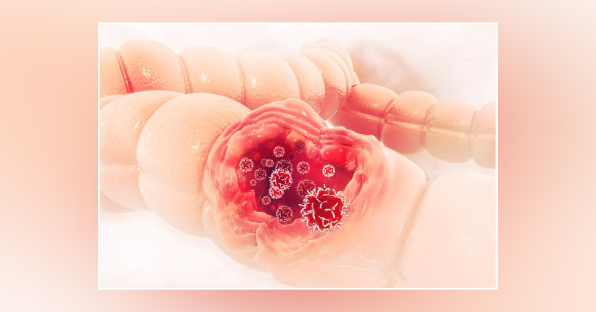 New Study-Annual, Noninvasive Stool Test Effective For Colon Cancer Screening Viable Alternative To Colonoscopy