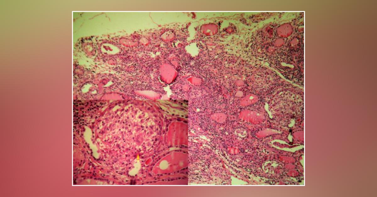 Rapid Enlargement of the Thyroid Gland