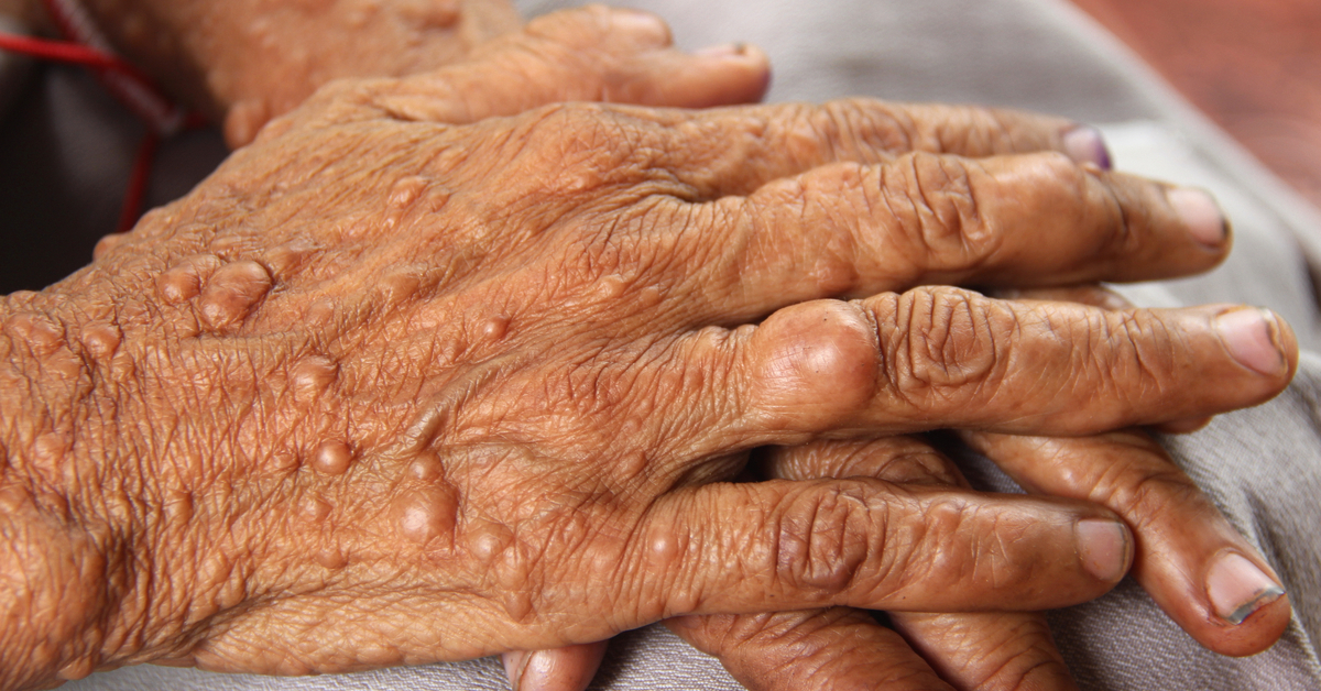 Ocular Manifestations Of Neurofibromatosis