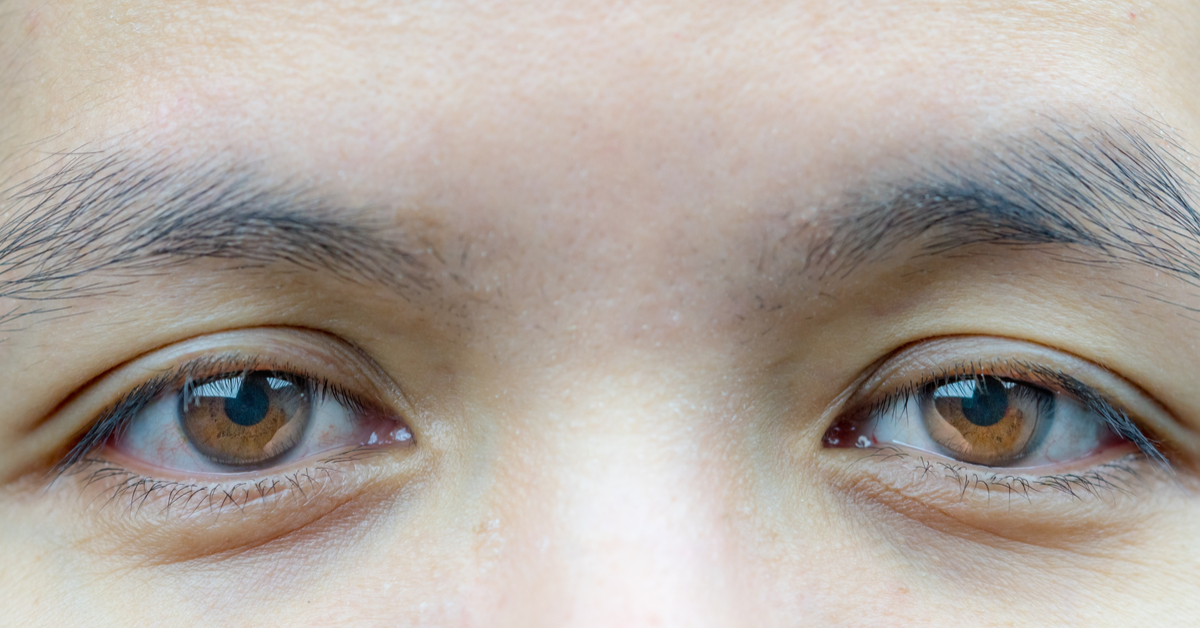 Types Of Ptosis