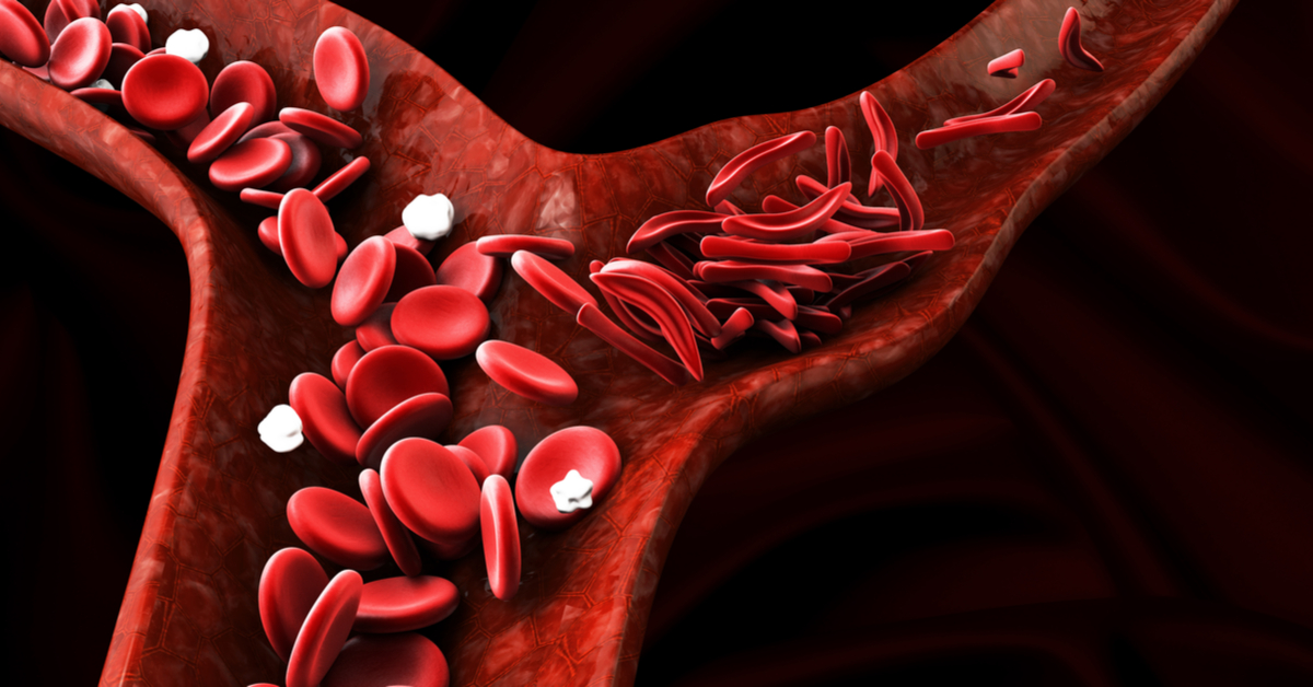 Post Segment Manifestations Of Sickle Cell Anemia