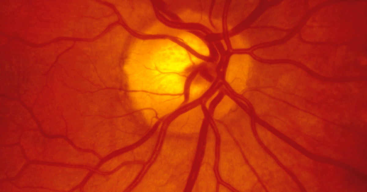 Causes Of Angioid Streaks