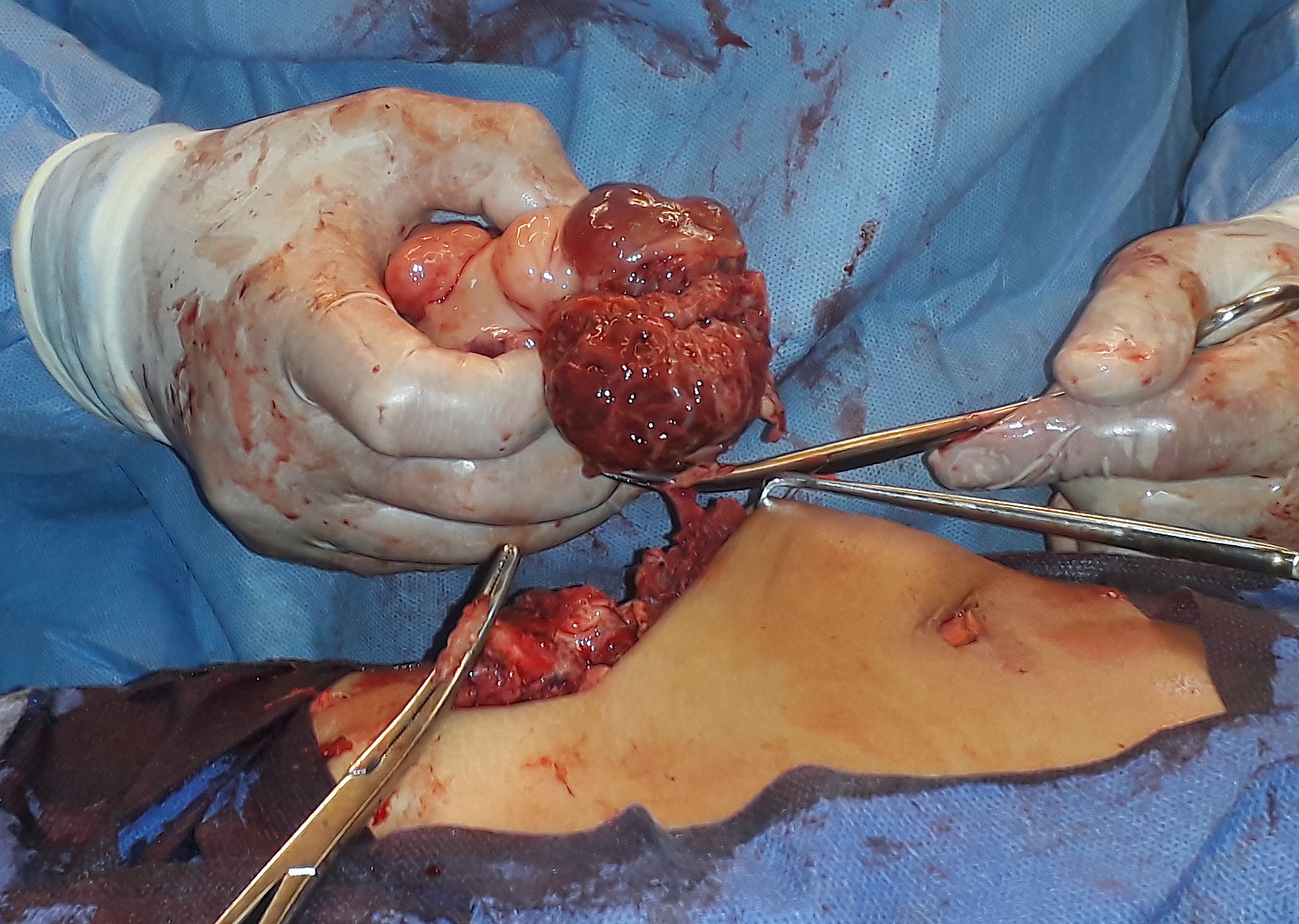 Urachal Swelling