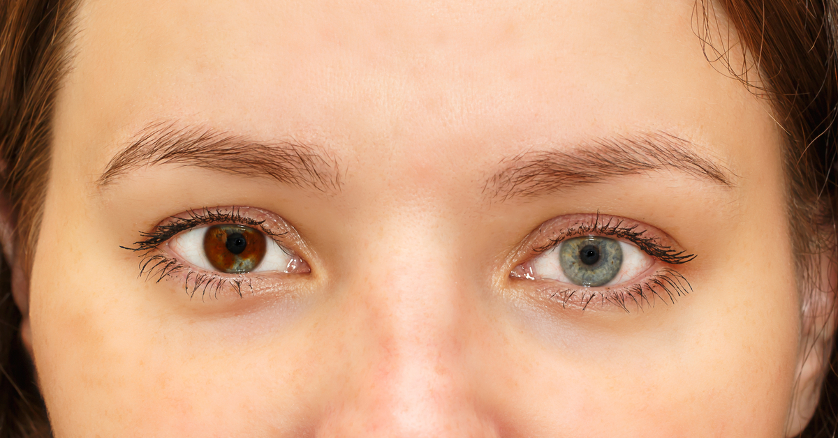 Causes Of Heterochromia