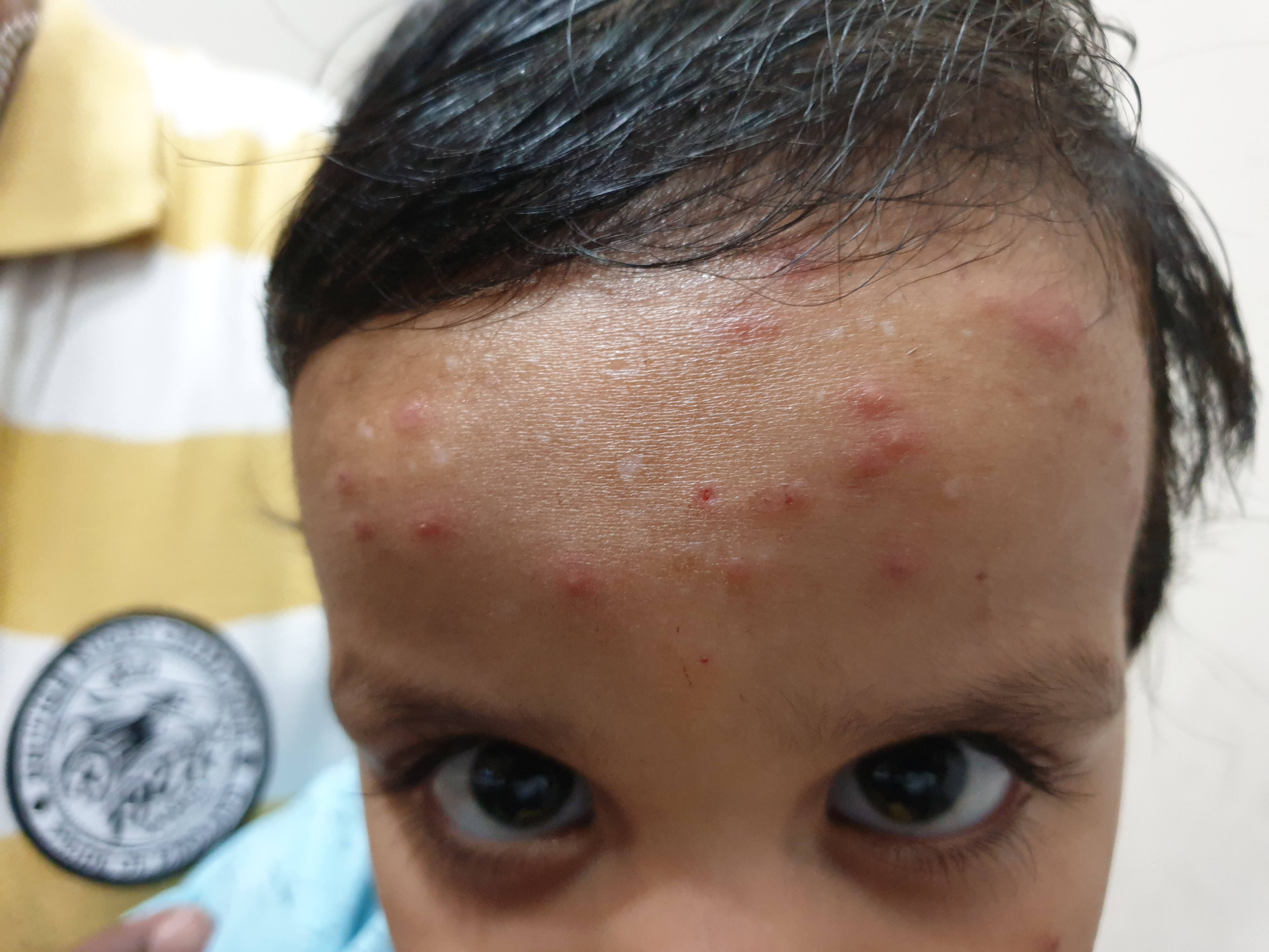 Recurrent Nodular Lesions