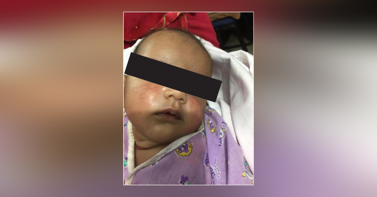 What Is The Treatment Of Atopic Dermatitis In Infants?