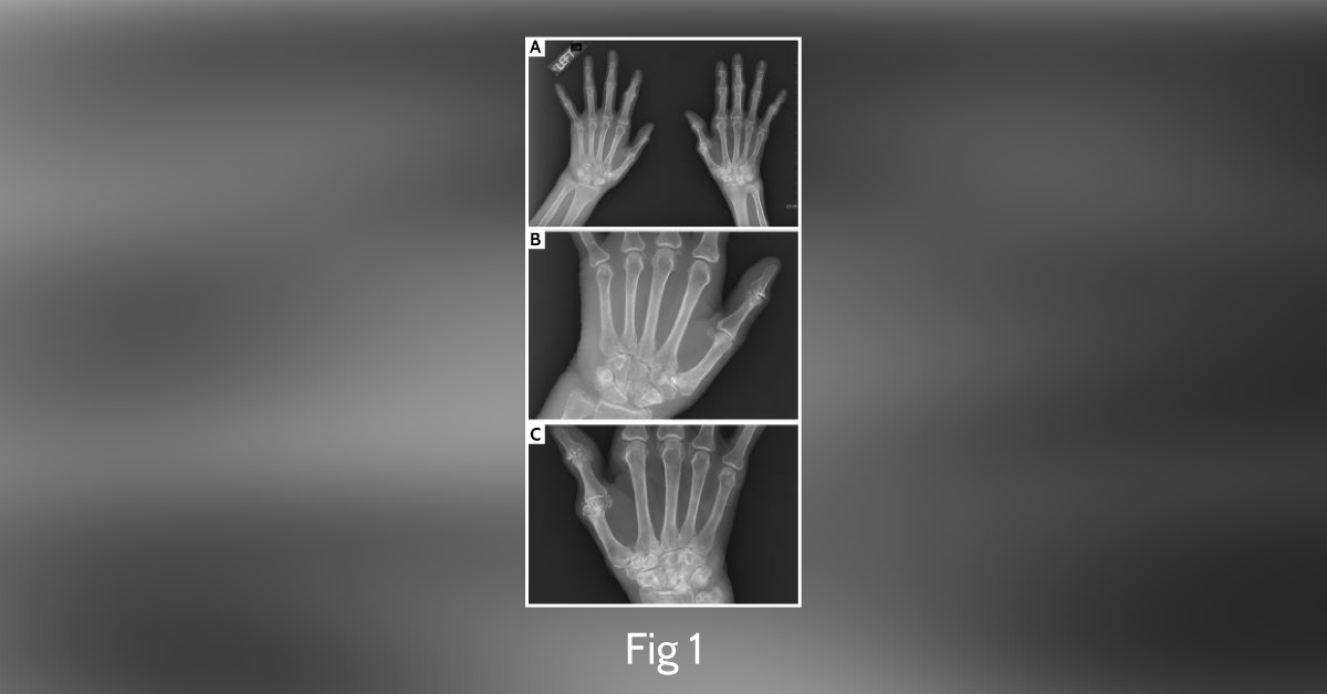 A Common Cause of Joint Pain: A Case Report (Part 1)