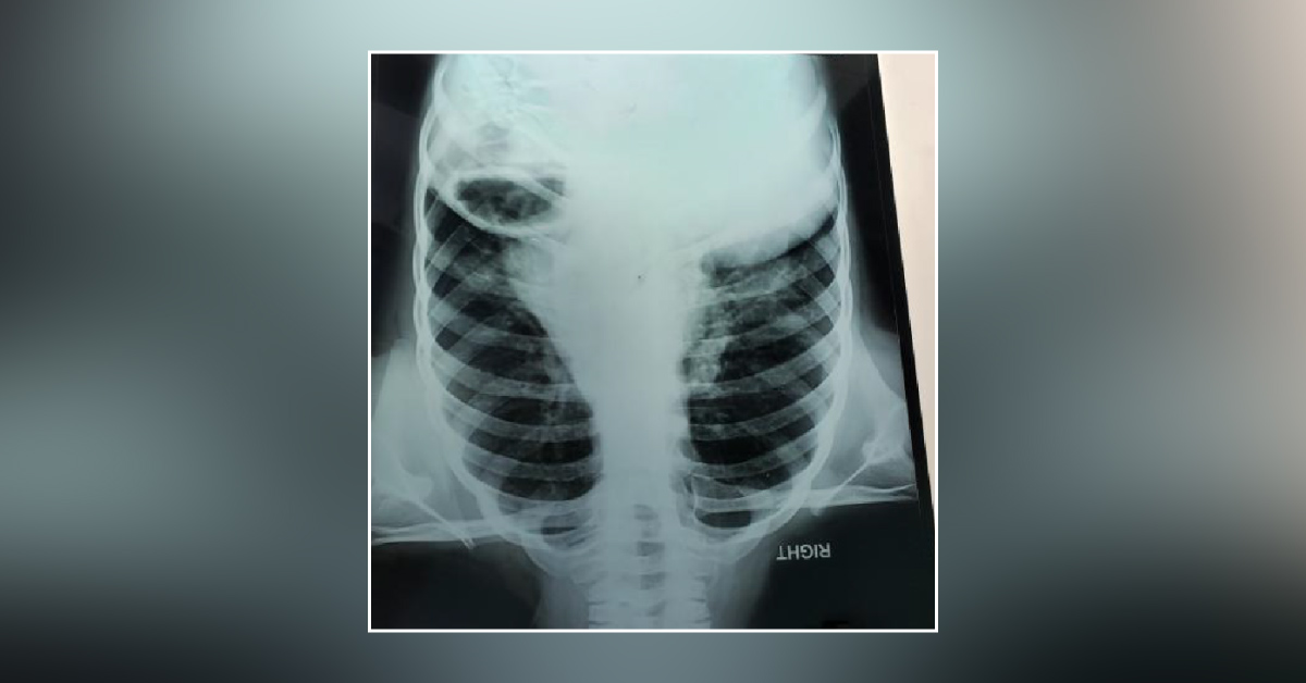 Why Is This Child's Cough, Not Responding To Treatment?