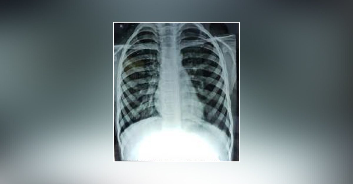 Look At Two X-Rays Of A Child And Give Opinion!