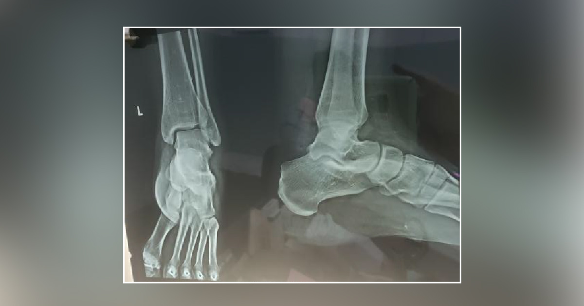 Is There Fracture Of Talus Bone In Lt Ankle Joint?