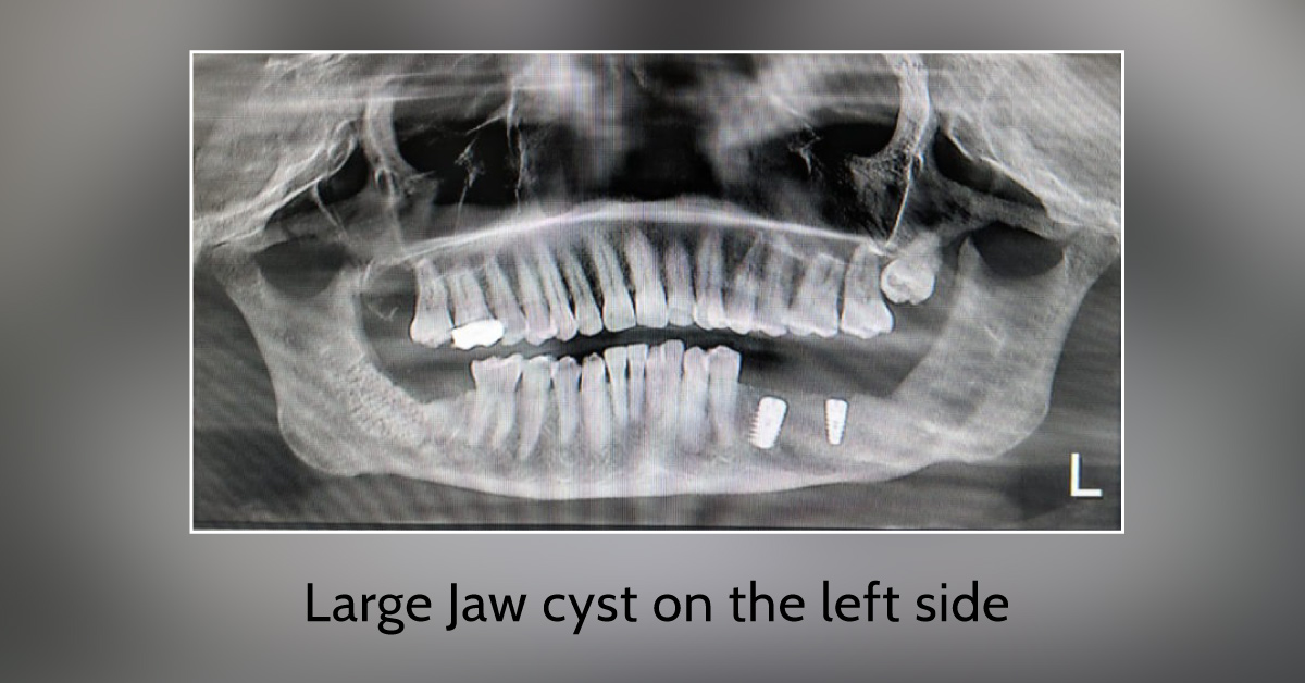 Surgery To Remove A Jaw Cyst. Will Life Be The Same After? Lose The Disease, Regain The Jaw