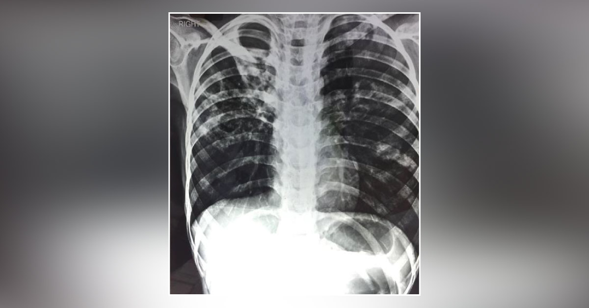 Is This TB Or Not?