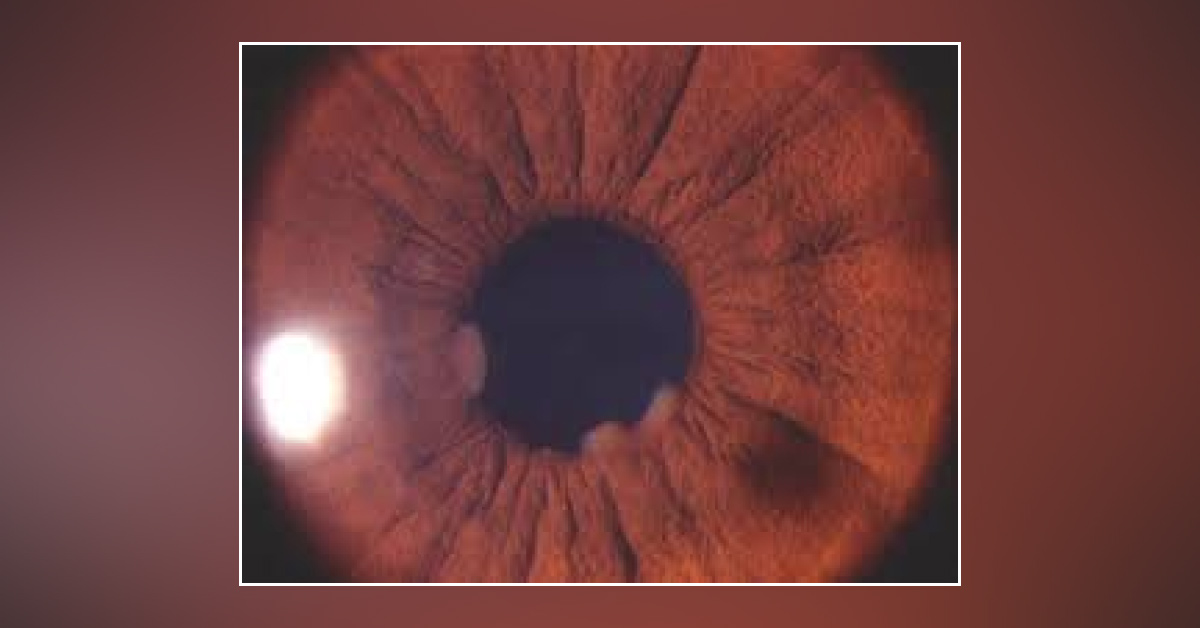 Post segment manifestations of sarcoidosis