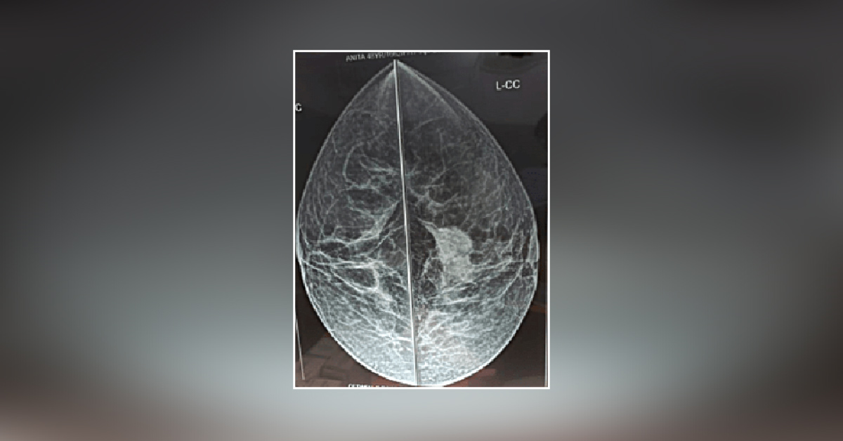 A Case Of Nodular Lump In Breast