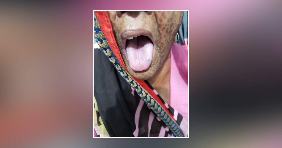 Identify Black Spot On Tongue