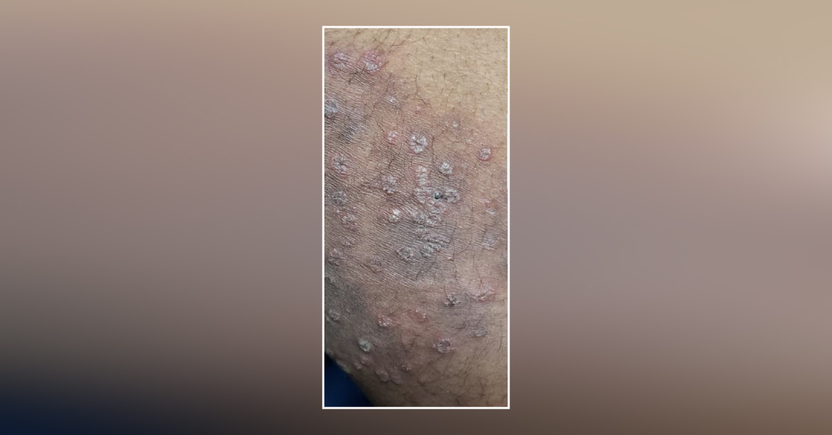 Describe This Lesion For Me