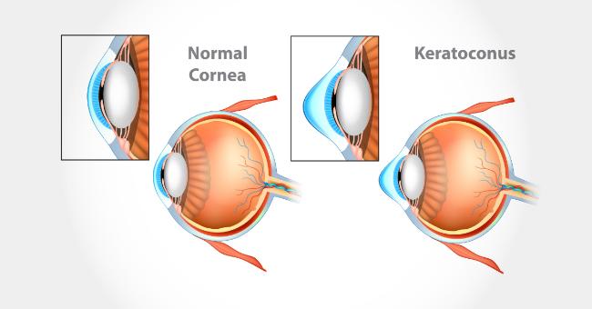 Cardinal Signs Of Keratoconus
