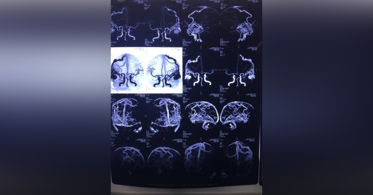 Optimal Management Of The 50 Year Old Pt.with AVM