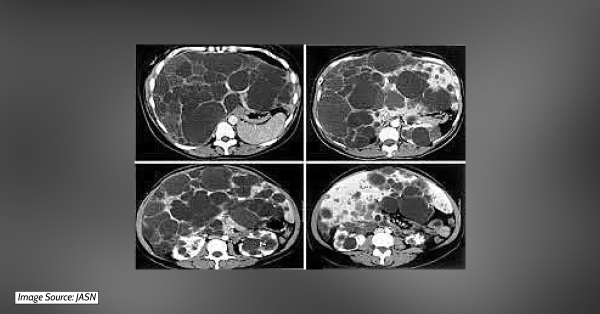 Lanreotide A New Medicine To Correct Polycystic Liver & Kidney