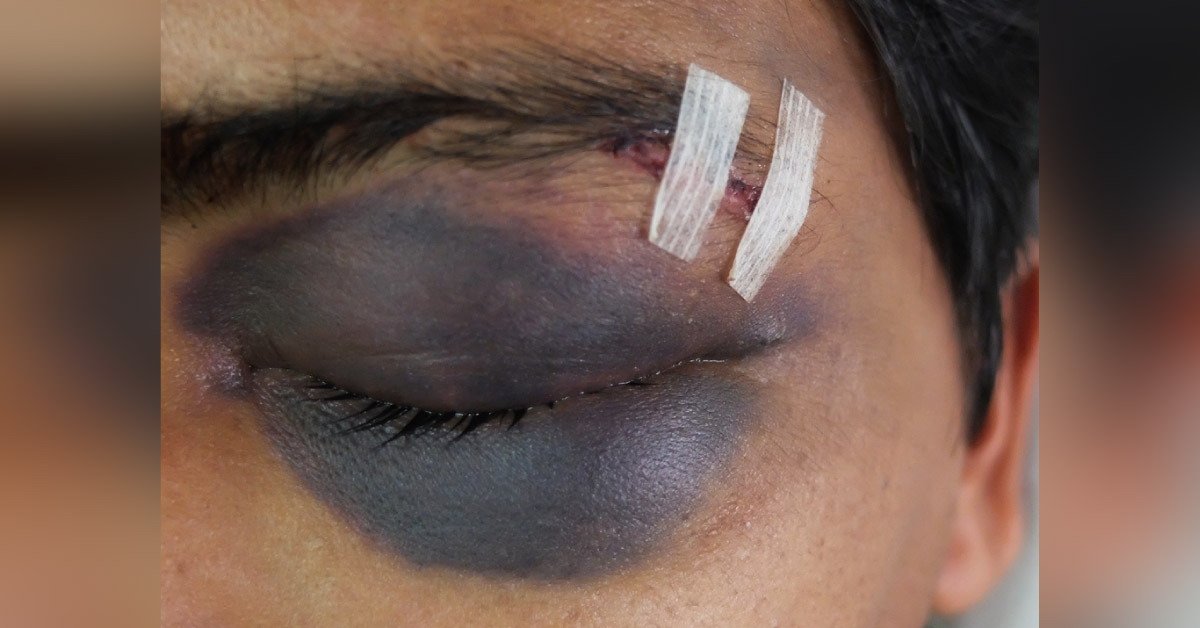 Brief On Blow Out Orbital Fracture
