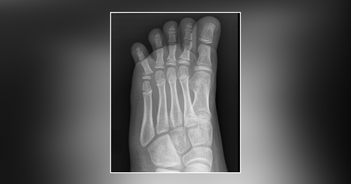 An Aching Toe